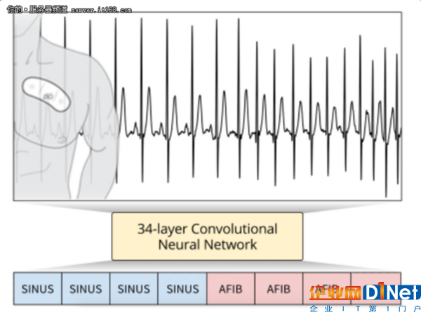 新的深度學習算法可診斷心律失常